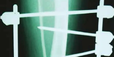 Teaser-halb-Externe-Fixation